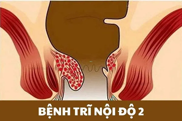 Bệnh trĩ độ 2 là gì? Các biểu hiệu chuyển biến thành bệnh trĩ độ 2