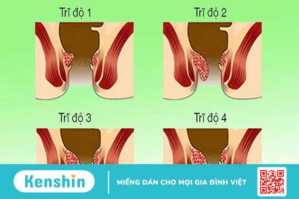 Bệnh trĩ là gì? 3 cách chữa trĩ hiệu quả tại nhà