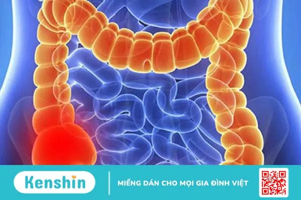 Bệnh viêm manh tràng và những điều cần biết