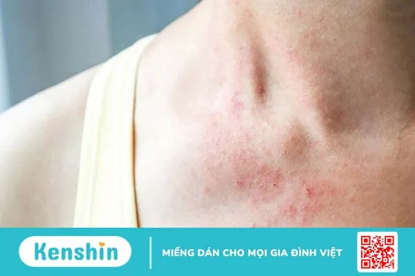 Bệnh zona thần kinh ở cổ là gì? Những thông tin cần biết