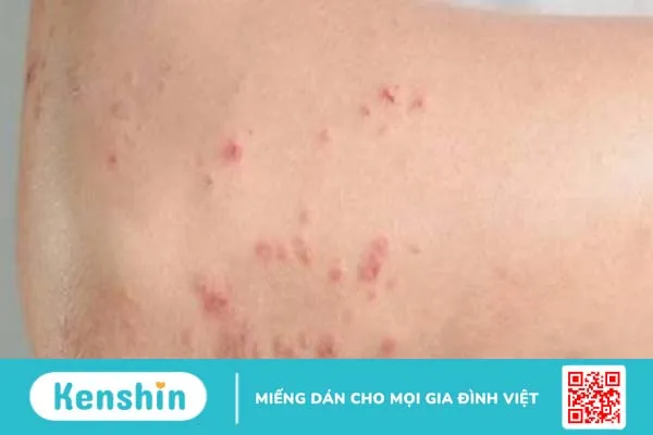 Bị nhiễm giun đũa chó khi mang thai có nguy hiểm không? Cách phòng tránh thế nào?