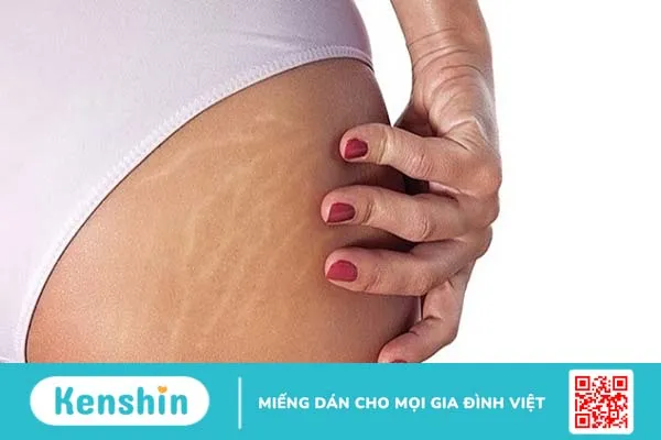 Bị rạn da mông màu trắng chữa thế nào?