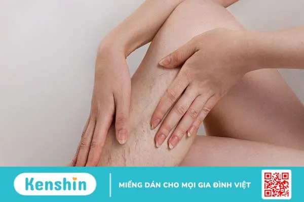 Bị suy giãn tĩnh mạch nên ăn gì? Lưu ý trong ăn uống cho bệnh nhân