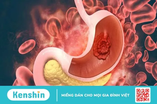 Bị thủng dạ dày có nguy hiểm không và cách điều trị như thế nào?