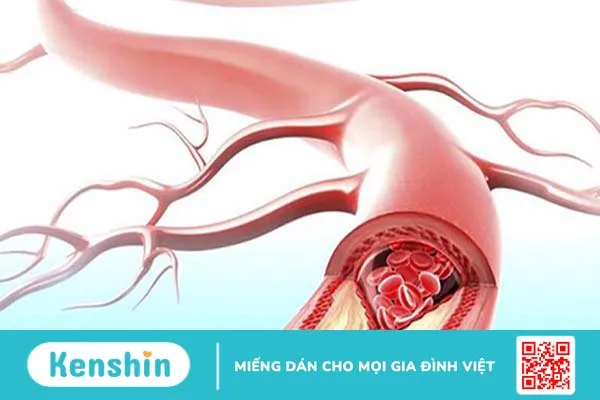 Biến chứng mạch máu nhỏ do tiểu đường có nguy hiểm không?