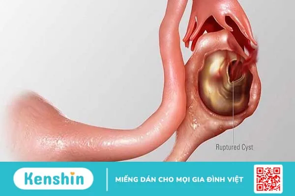 Biến chứng u nang buồng trứng bị vỡ có nguy hiểm không?