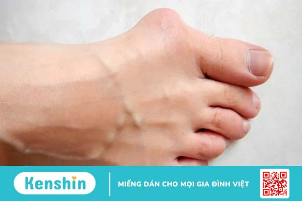 Biến dạng ngón chân cái là do đâu? Cách xử lý như thế nào?