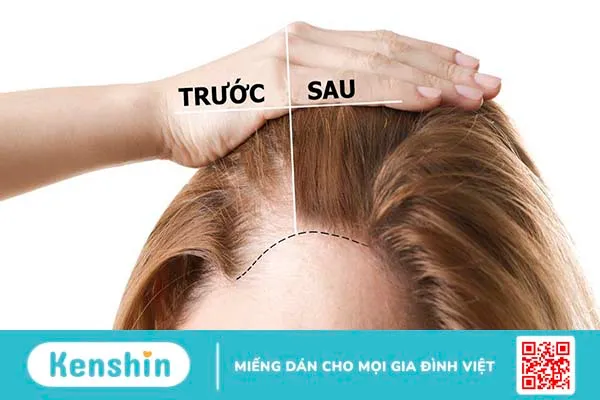 Bỏ túi 6 mẹo giúp kích thích mọc tóc hiệu quả tại nhà