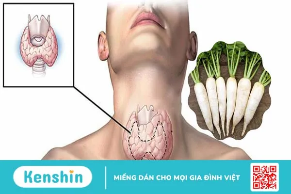 Bướu cổ ăn củ cải trắng được không? Bướu cổ ăn gì tốt?