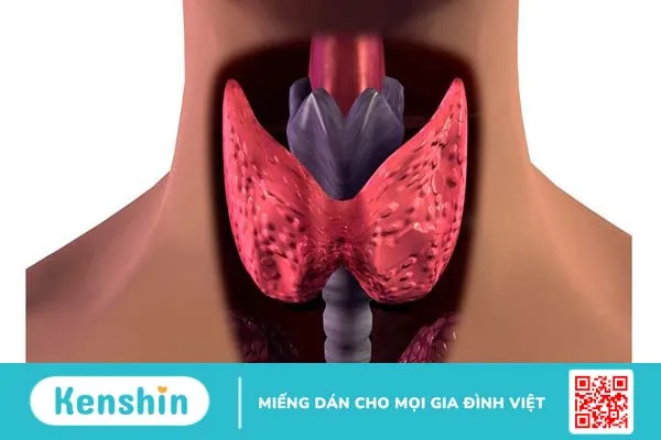 Bướu cổ đa nhân lành tính: Nguyên nhân, triệu chứng và cách phòng ngừa