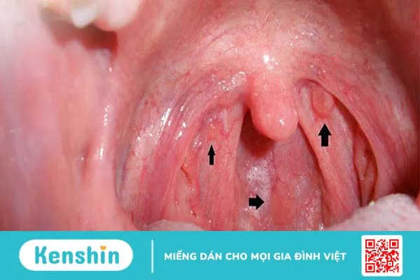 Các bệnh về họng thường gặp và cách điều trị