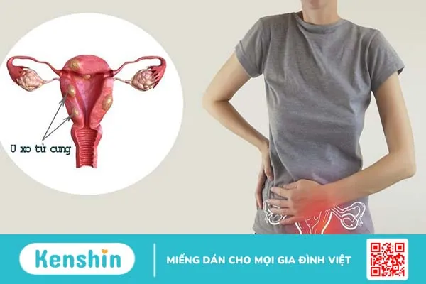 Các biến chứng u xơ tử cung thoái hóa