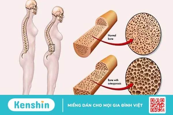 Các chỉ số khối lượng xương kiểm tra sức khỏe xương trong cơ thể