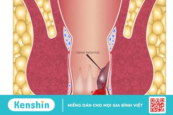 Các giai đoạn của bệnh trĩ ai cũng nên biết