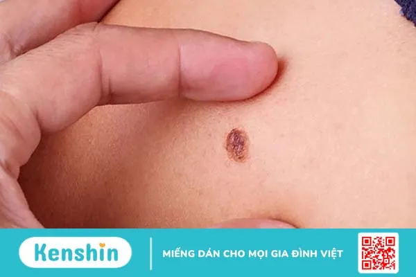 Các giai đoạn ung thư da cần biết và biện pháp phòng ngừa ung thư da hiệu quả