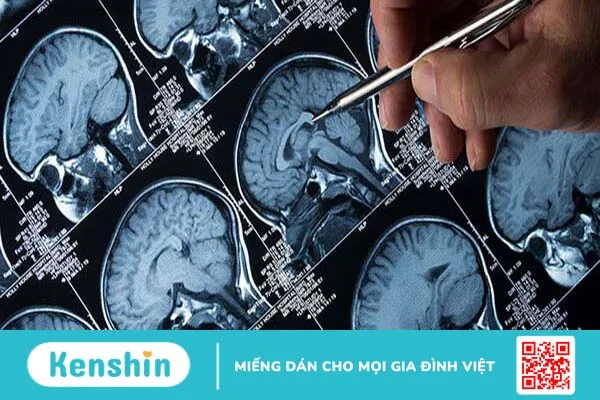 Các kỹ thuật chẩn đoán hình ảnh u não hiệu quả hiện nay