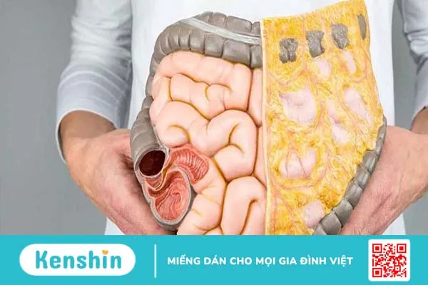 Các loại bệnh đường ruột mùa hè bạn cần chú ý