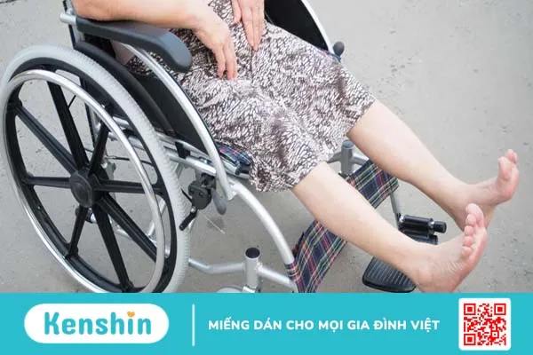 Các loại liệt thường gặp: Nguyên nhân và cách điều trị