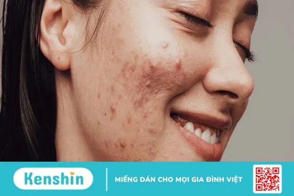 Các loại mụn viêm dưới da và cách điều trị