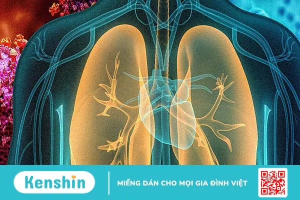 Các tiêu chuẩn chẩn đoán viêm phổi