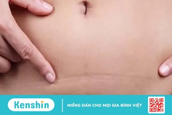 Cách chữa sẹo lồi sinh mổ hiệu quả