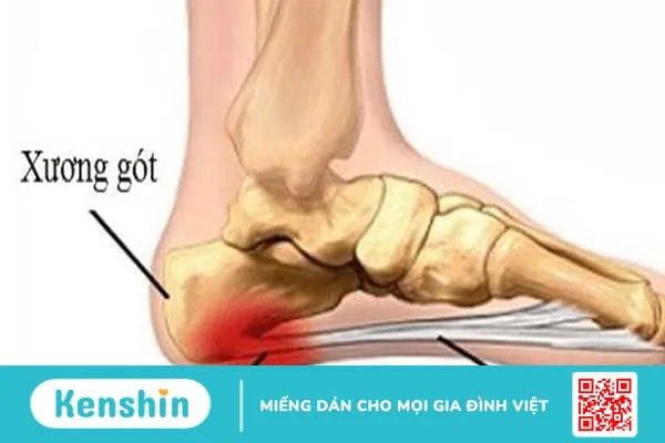 Cách chữa viêm cân gan bàn chân bằng phương pháp huyết tương giàu tiểu cầu (PRP)