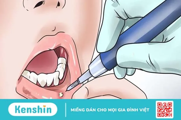 Cách chữa viêm loét miệng hiệu quả