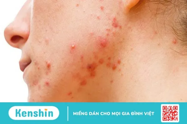 Cách làm xẹp mụn sưng đỏ sau 1 đêm bạn đã biết chưa?