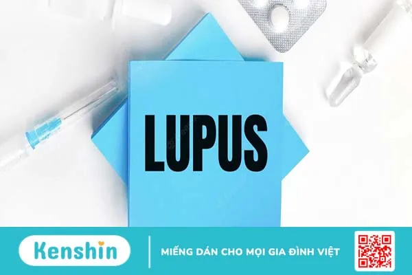 Cách nhận biết biểu hiện của lupus ban đỏ hệ thống