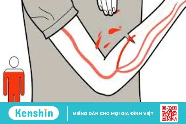 Cách sơ cứu vết thương chảy máu mao mạch và tĩnh mạch đúng cách, an toàn