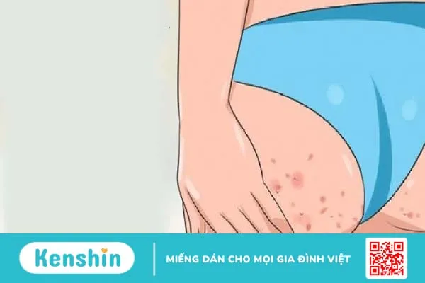 Cách trị mụn thâm ở mông đơn giản tại nhà