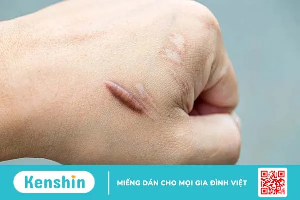 Cần kiêng ăn bao lâu để tránh sẹo lồi, bạn đã biết rõ chưa?