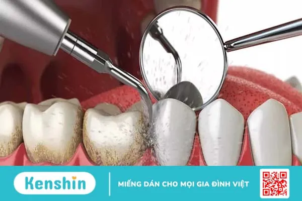 Cao răng là gì? Phân độ cao răng, cách loại bỏ và phòng ngừa cao răng