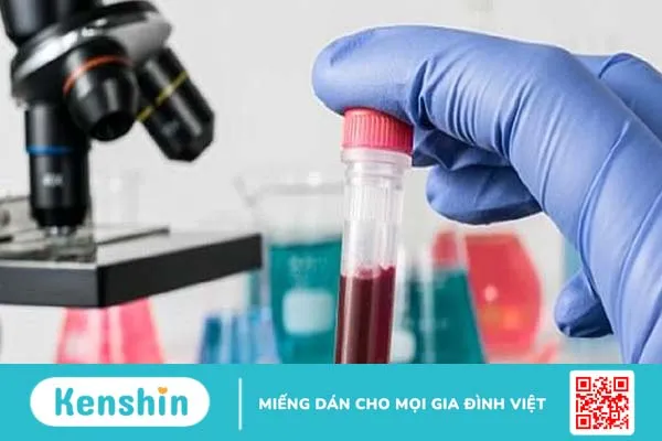 Cardiolipin antibody là gì? Khi nào cần thực hiện xét nghiệm kháng thể kháng cardiolipin antibody?