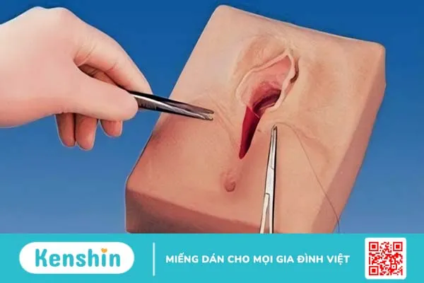 Cắt môi bé bao lâu thì lành? Những điều cần lưu ý khi thực hiện phẫu thuật cắt môi bé