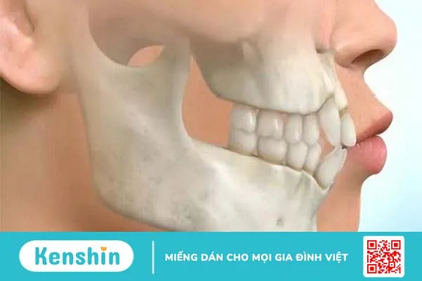 Cấu trúc giải phẫu xương hàm trên