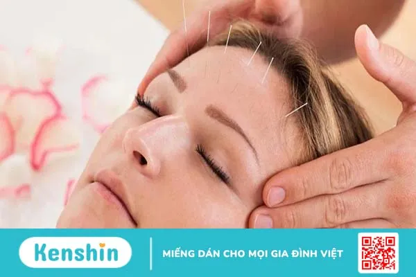 Châm cứu liệt dây thần kinh số 7 ngoại biên