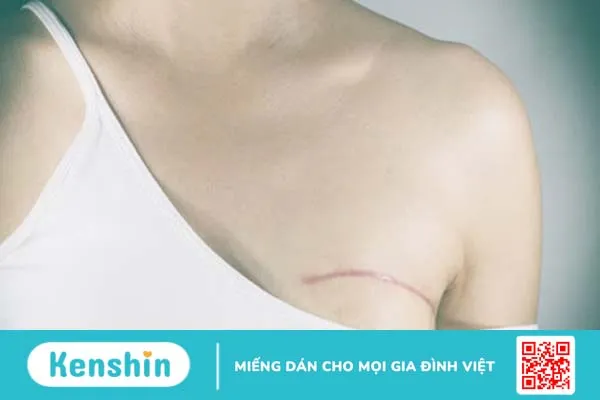 Chăm sóc tại gia đình sau phẫu thuật – Dành cho bệnh nhân ung thư vú