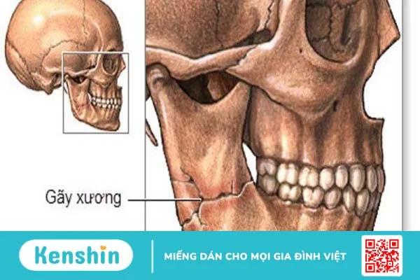 Chấn thương hàm mặt: Phân loại chấn thương và cách xử trí