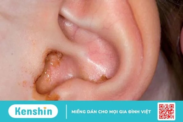 Chảy mủ tai ở trẻ em và những điều ba mẹ cần biết