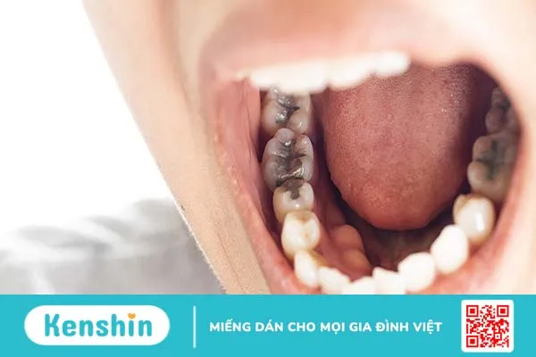 Chi phí trám răng là bao nhiêu? Trám răng bao lâu thì phải làm lại?