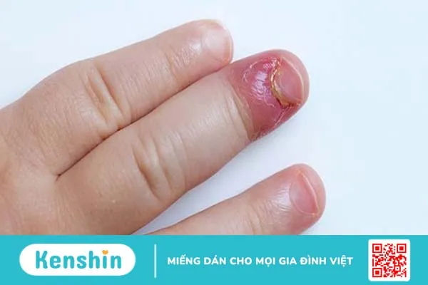 Chín mé ngón tay: Triệu chứng và cách phòng ngừa