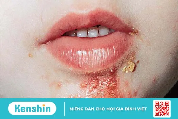 Chốc lở thể mủ và những điều cần biết