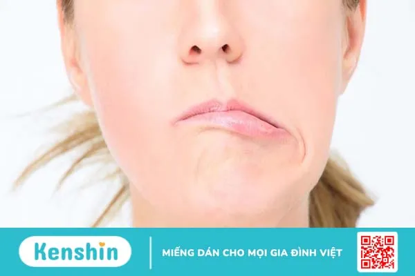 Chữa bệnh liệt mặt lâu năm có hy vọng không?