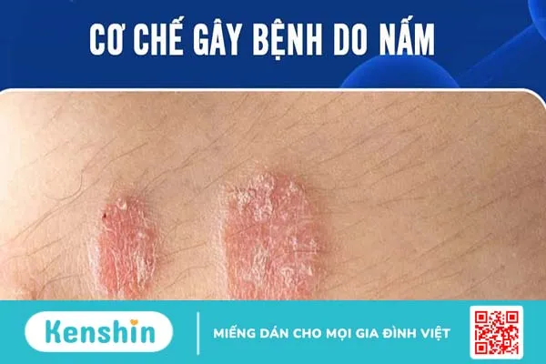 Cơ chế gây bệnh do nấm khi nấm xâm nhập vào cơ thể