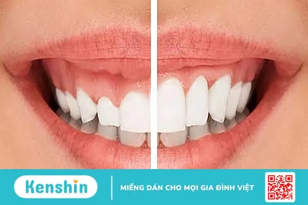 Cung răng là gì? Nhận biết cung răng đẹp như thế nào?