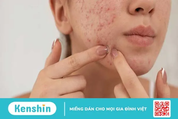 Da bị vết thâm mụn mãi không hết phải làm sao?