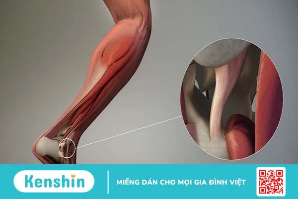 Đặc điểm cấu tạo của dây chằng và những chấn thương liên quan