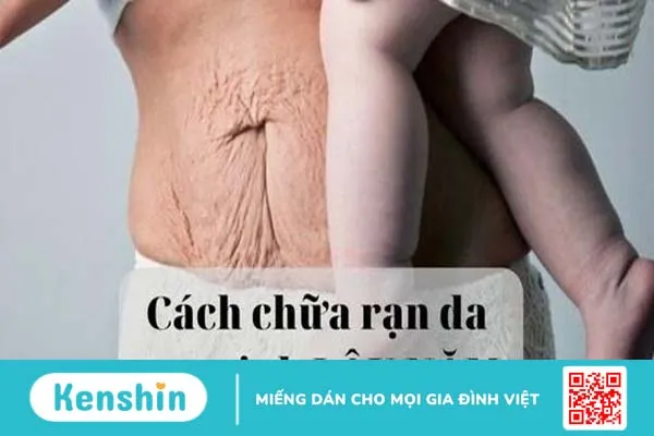 Đánh giá hiệu quả từng cách chữa rạn da sau sinh lâu năm