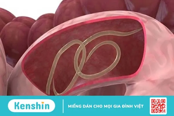 Dấu hiệu lâm sàng người mắc bệnh giun xoắn